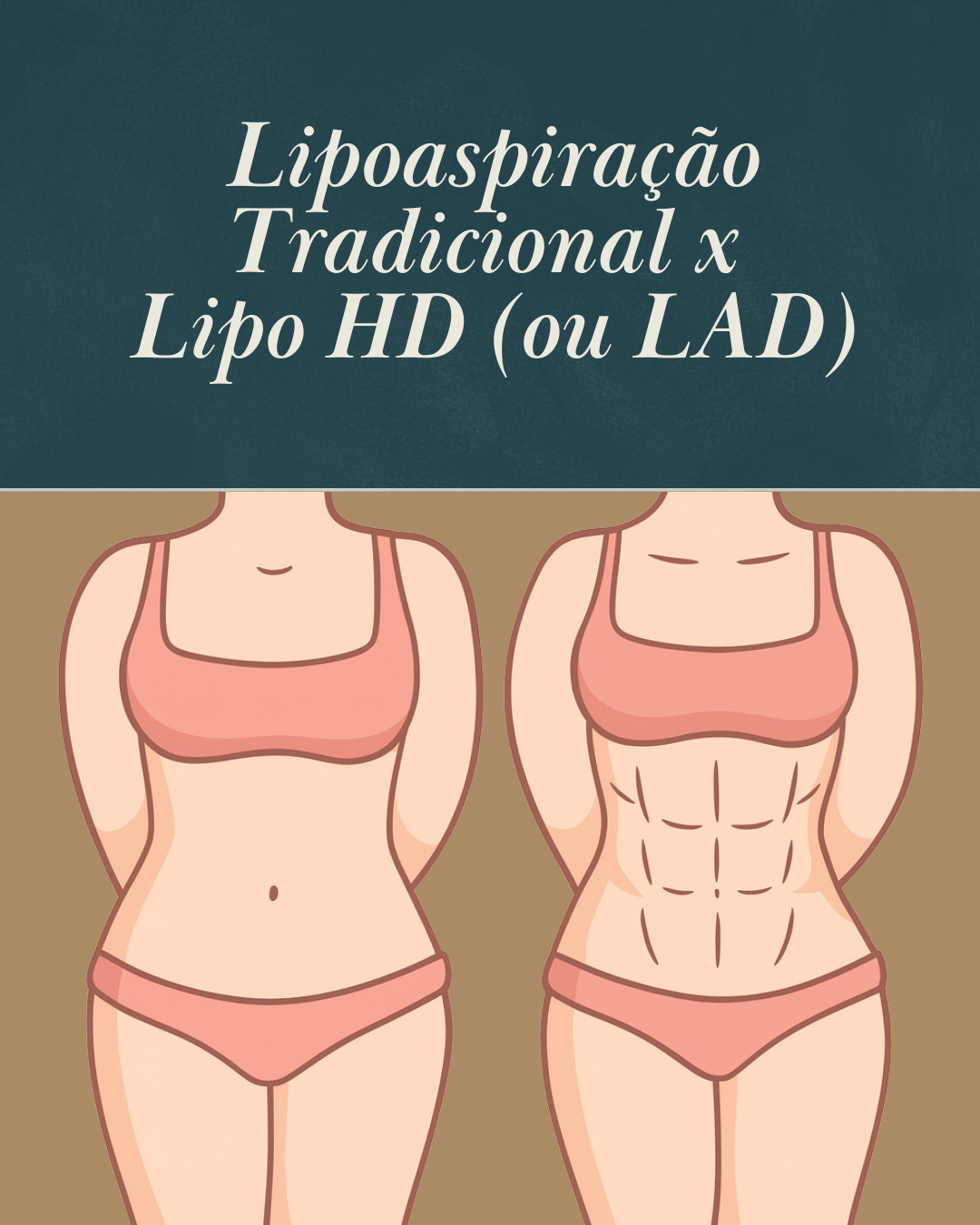 Lipoaspiração tradicional x Lipo HD (ou LAD): entenda as diferenças entre as técnicas
